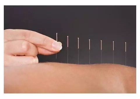 Acupuncture